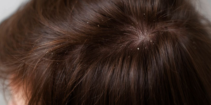 prevent dandruff